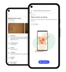 dermatology assist google aplikacija veštačka inteligencija