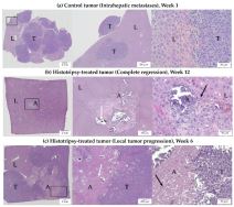 Proces lečenja histotripsijom