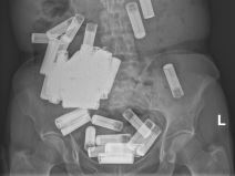 Lekari izvadili 55 baterije iz stomaka žene