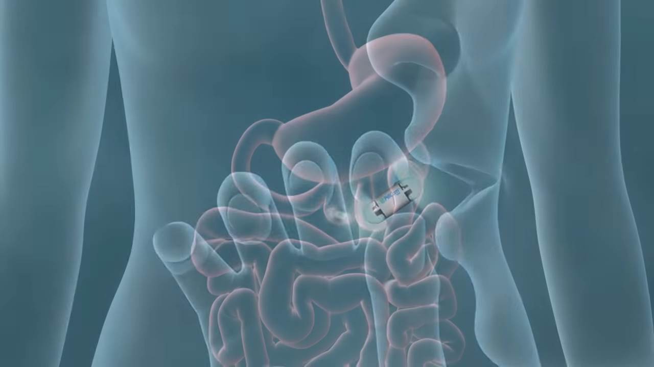 pilule sa kamerama rak creva zdravlje endoskopija 