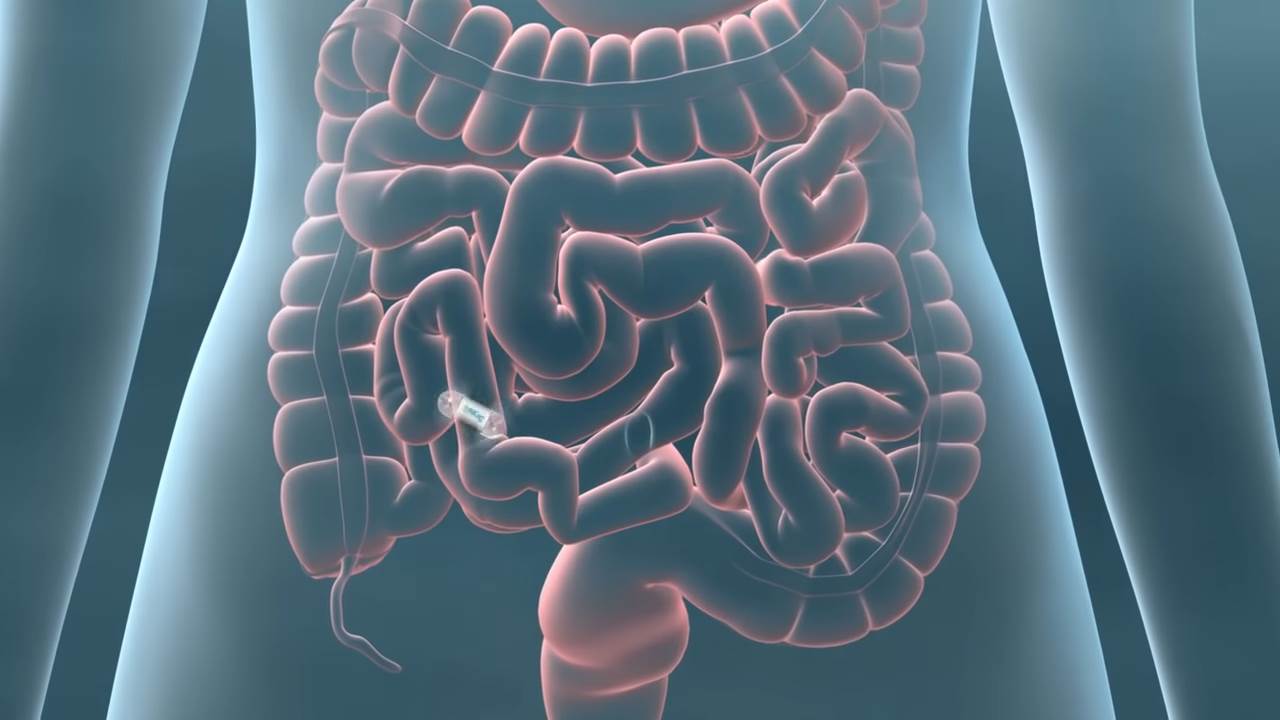 pilule sa kamerama rak creva zdravlje endoskopija 