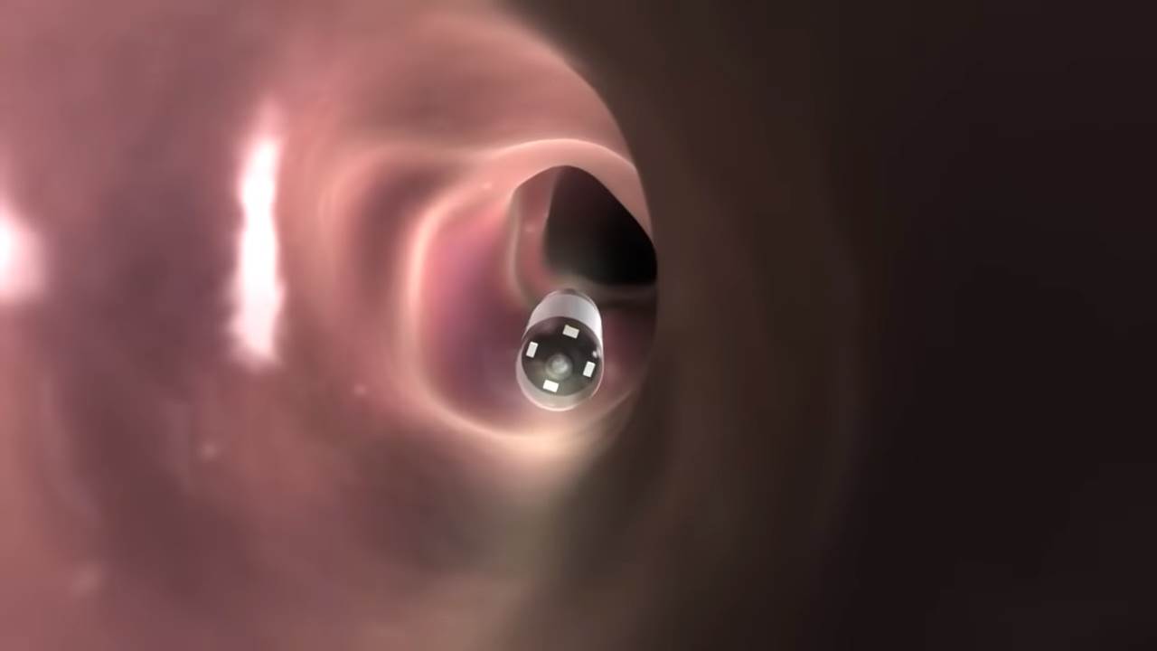 pilule sa kamerama rak creva zdravlje endoskopija 