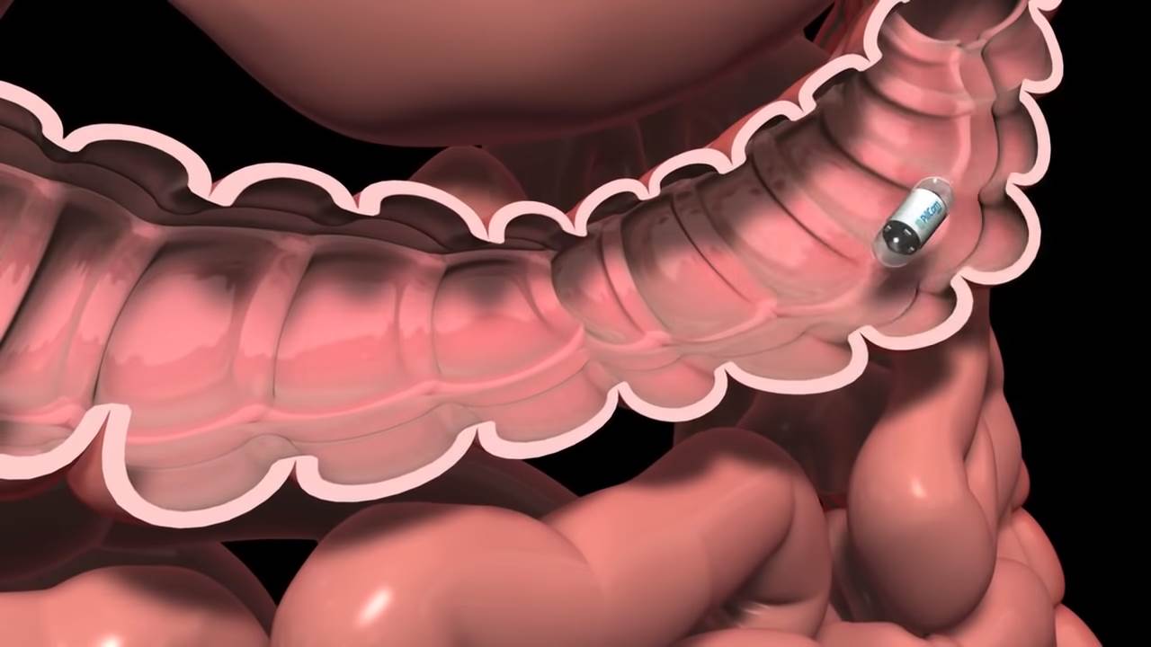pilule sa kamerama rak creva zdravlje endoskopija 
