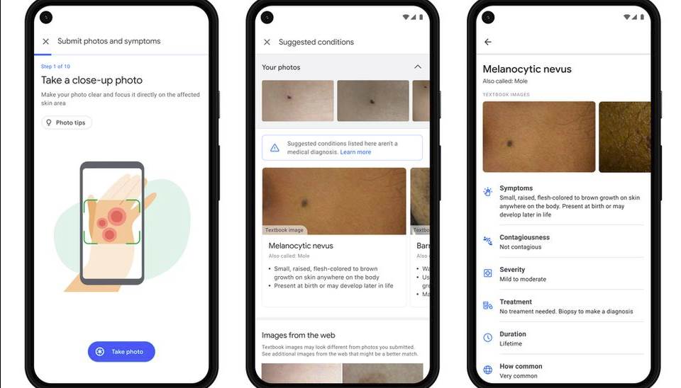 dermatology assist google aplikacija veštačka inteligencija