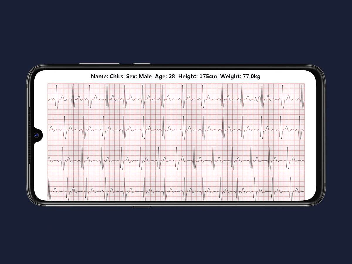 pametna majica fitnes ekg merenje