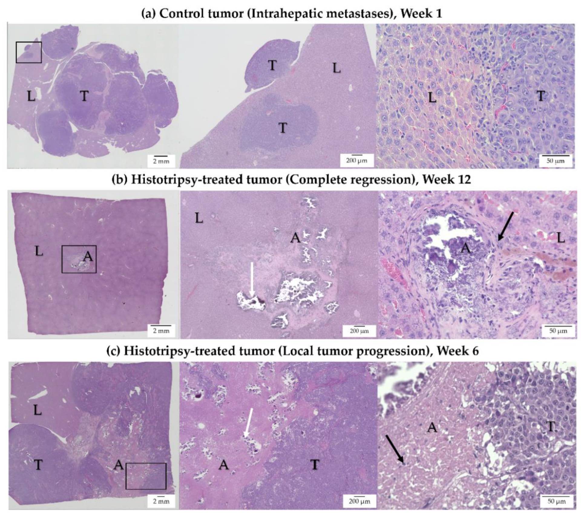 Proces lečenja histotripsijom