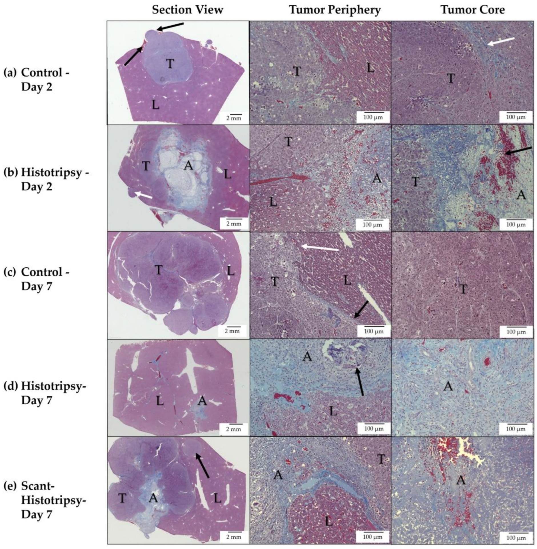 Histotripsija lečenje